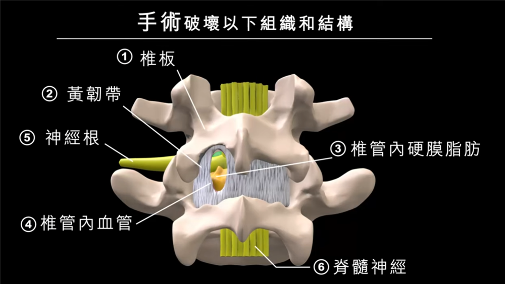術後脊椎手術視野圖片